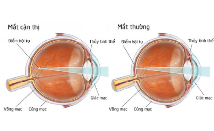 Sự khác nhau của mắt thường và mắt cận thị