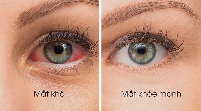 Sự khác nhau giữa một đôi mắt bị khô và bình thường