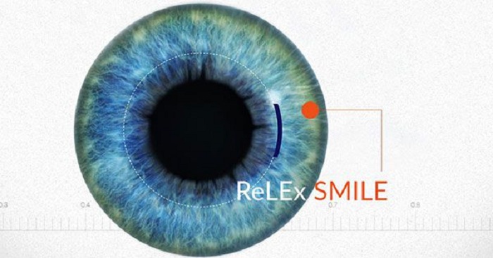 Relex smile là kỹ thuật chữa tật khúc xạ không tạo vạt