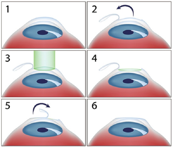 Phương pháp phẫu thuật mắt chữa cận thị