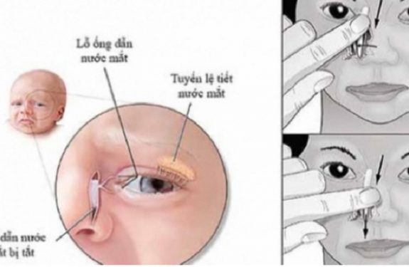 Cách day mắt cho trẻ bị tắt tuyến lệ