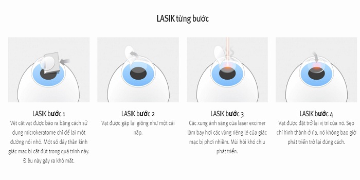 Các bước mổ mắt cận bằng Lasik