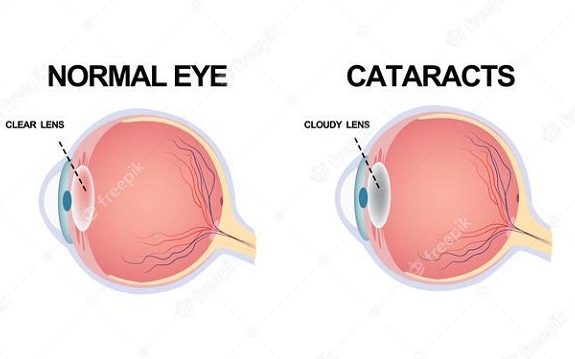 Cấu cúc của mắt bình thường và mắt bị đục thủy tinh thể