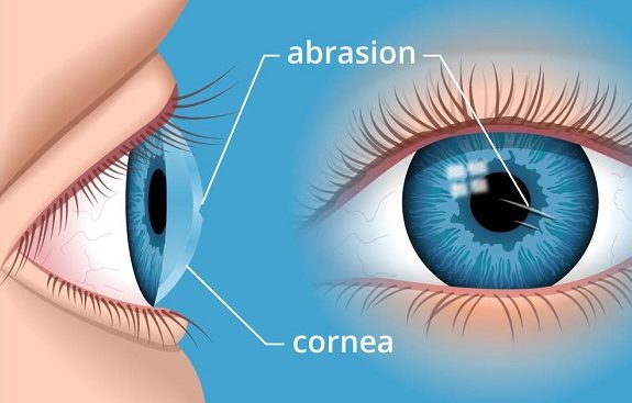 tạo ra vết thương hở làm tăng nguy cơ nhiễm trùng mắt 