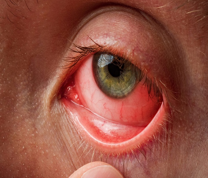 Nhiễm trùng mắt nguyên nhân, cách phòng ngừa và điều trị