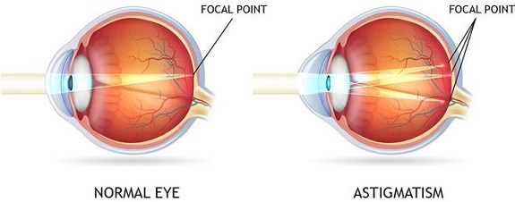 Loạn thị là một tật khúc xạ của mắt, hình ảnh sau khi vào trong mắt sẽ bị hội tụ tại nhiều điểm gây hiện tượng nhìn mờ, nhoè 