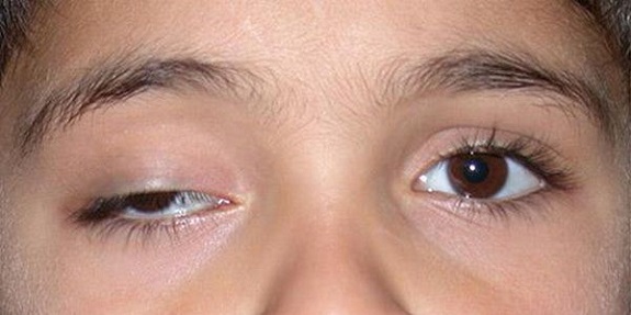 Sụp mí mắt là tình trạng bờ mi trên và phần da mi mắt bị trùng xuống 