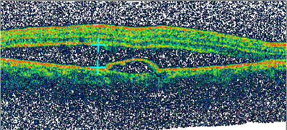 Kỹ thuật chụp các lớp quang học OCT chẩn đoán phù hoàng điểm
