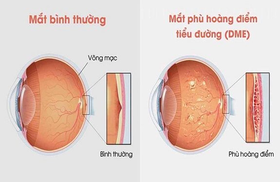 Phù hoàng là bệnh lý mà tại điểm vàng của mắt xảy ra tình trạng sưng phù gây ảnh hưởng tới thị lực