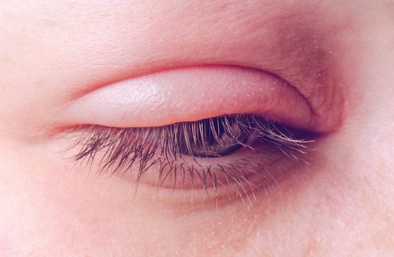 Sưng mi mắt là tình trạng mi mắt trên hoặc dưới sưng lên khác thường