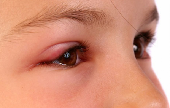 Sưng mi mắt: Nguyên nhân và Cách khắc phục hiệu quả nhất