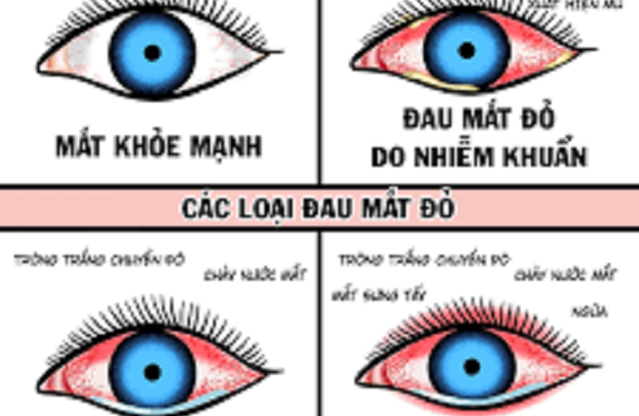 Đau mắt đỏ và các nguyên nhân gây bệnh