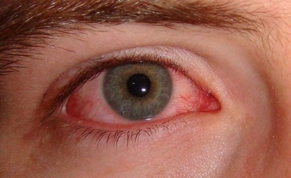 Mắt đổ ghèn có thể là triệu chứng của nhiều bệnh lý khác nhau cần phải thận trọng