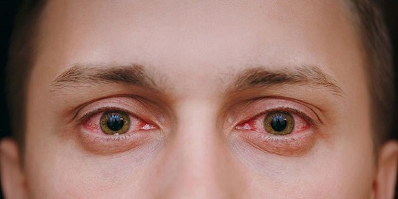 Đau mắt đỏ do vi khuẩn hoặc vi rút đều có thể lây từ người này sang người khác