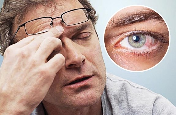 Mắt bị khô cũng là nguyên nhân gây ngứa