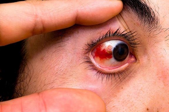 Mắt bị đỏ 1 bên nhưng không đau là bệnh gì? Phải làm sao?