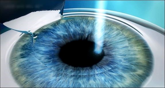 Phẫu thuật Lasik là phẫu thuật điều chỉnh thị lực ở những người bị cận thị, viễn thị hoặc loạn thị bằng tia cực tím laser excimer.